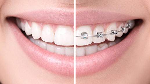 resultado de tratamiento de ortodoncia con alineadores invisibles antes y después